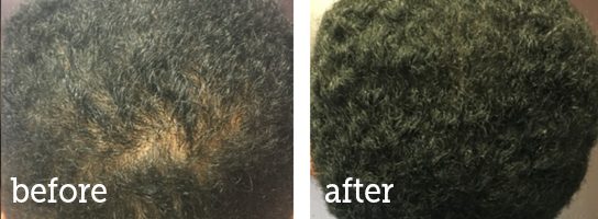 Microneedling-dark-hair-BA