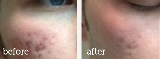 Microneedling-facial-acne-scars-BA