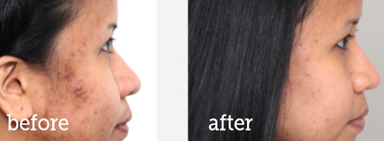 Microneedling-facial-brown-spots-BA