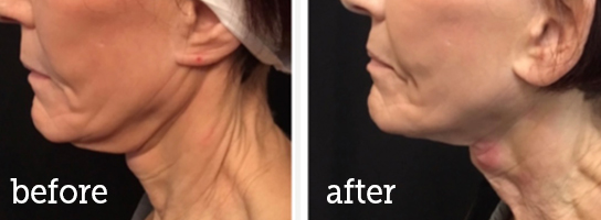 Microneedling-neckline-BA