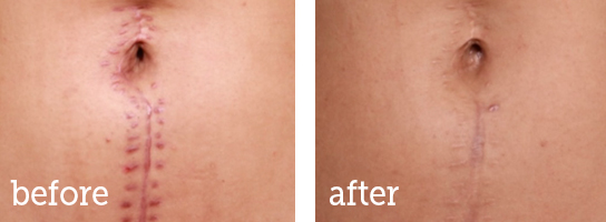 Microneedling-stomach-scars-BA